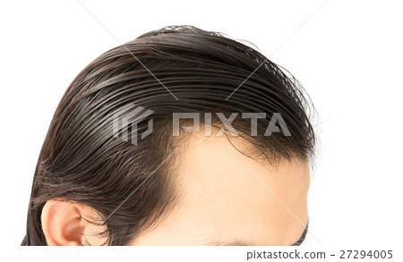 Closeup young man serious hair loss problem Closeup young man serious hair loss problem 27294005
