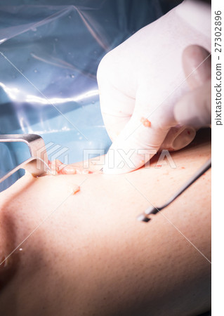 Surgical operation knee surgery Surgical operation knee surgery 27302896