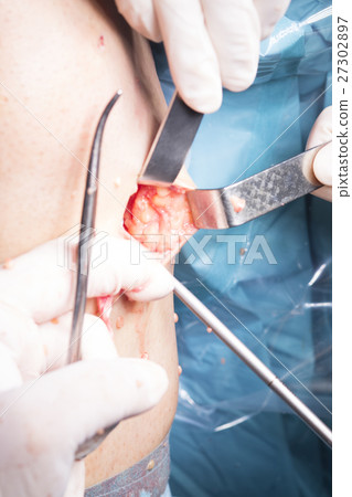 Surgical operation knee surgery Surgical operation knee surgery 27302897