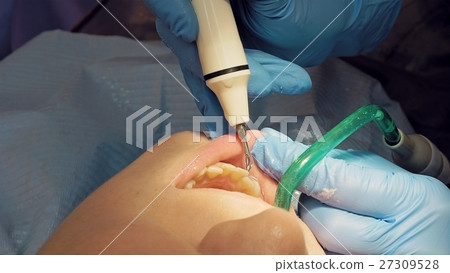 Woman ultrasonic tooth plaque odontolith removing 27309528