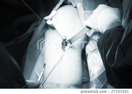 Surgical operation knee surgery 27333301