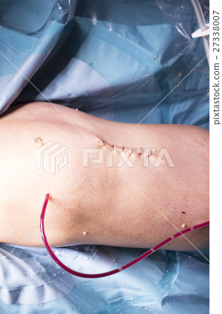 Surgical operation knee surgery 27338007