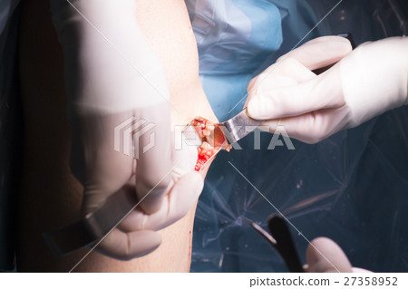 Surgical operation knee surgery Surgical operation knee surgery 27358952