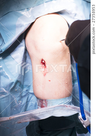 Surgical operation knee surgery 27358953