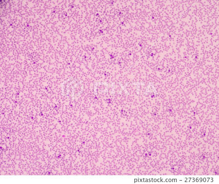 Sepsis or septicaemia is a life-threatening  27369073