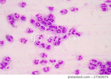 Sepsis or septicaemia is a life-threatening  27369074