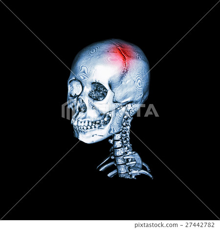 Stroke . Stroke . 27442782