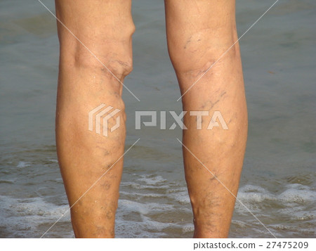 varicose veins 27475209