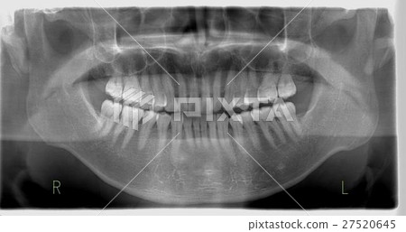 Dental radiograph (normal image) 27520645