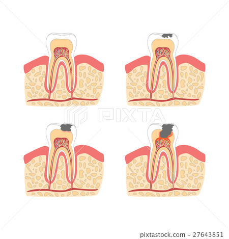 Cartoon Tooth with Stages of Dental Caries 27643851