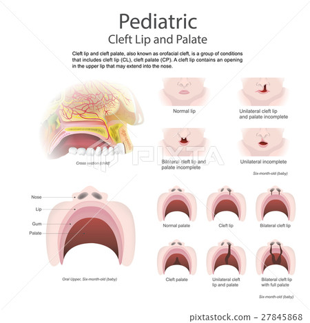 Cleft lip, vector, Illustration Cleft lip, vector, Illustration 27845868