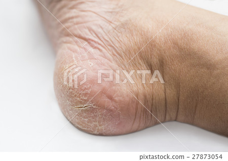 Crack of heel 27873054