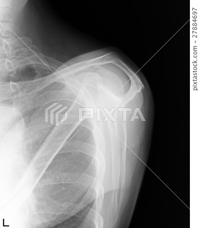 X-ray photo shoulder chest X-ray photo shoulder chest 27884697