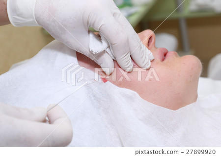 Procedure of face lifting surgery. 27899920