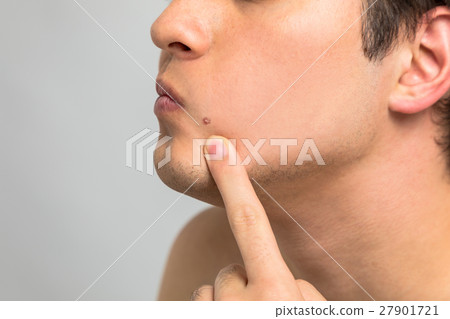 A man you care about acne A man you care about acne 27901721