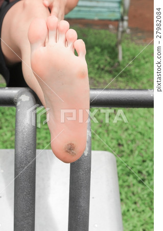 foot corn :Select focus with shallow depth of field. 27982084