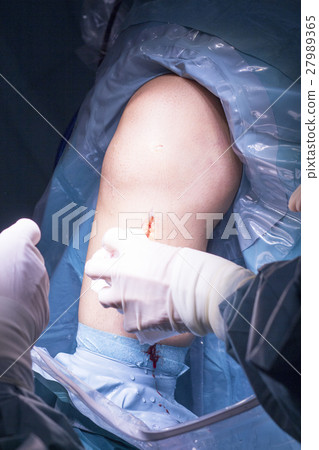 Surgical operation knee surgery Surgical operation knee surgery 27989365