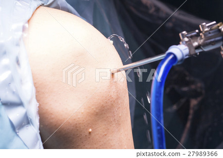 Surgical operation knee surgery 27989366