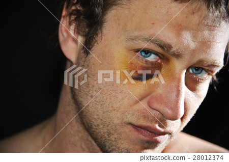Bruised eye of a sportsmen. 28012374