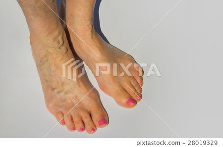 Varicose veins on a female legs Varicose veins on a female legs 28019329