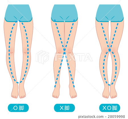 Distortion of O leg legal pelvis 28059998