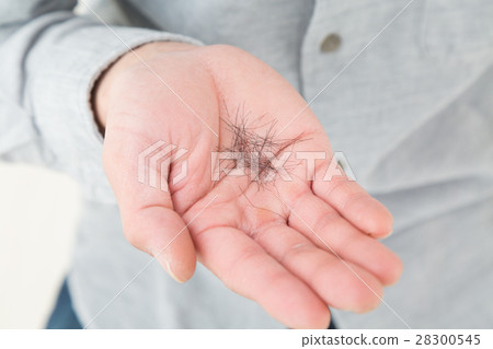 Young male hair loss image Young male hair loss image 28300545