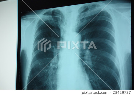 胸部X光檢查 胸部X光檢查 28419727