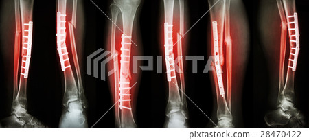 Collection image of leg fracture Collection image of leg fracture 28470422