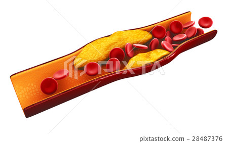 3d Illustration of blood cells with plaque buildup 3d Illustration of blood cells with plaque buildup 28487376