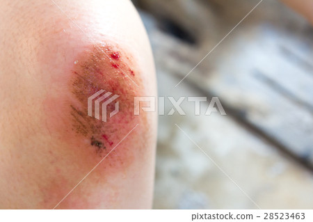 Bruised wound injury on woman knee background 28523463