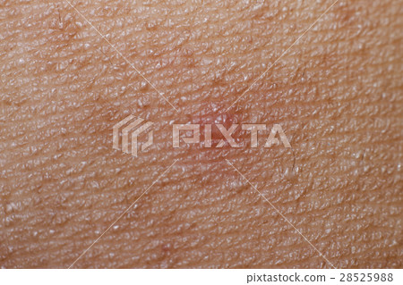 Soft Wounds on the skin 28525988