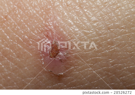 Soft Wounds on the skin 28526272