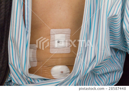 Wound after operation 28587448