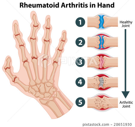 Diagram showing rheumatoid arthriitis in hand 28651930