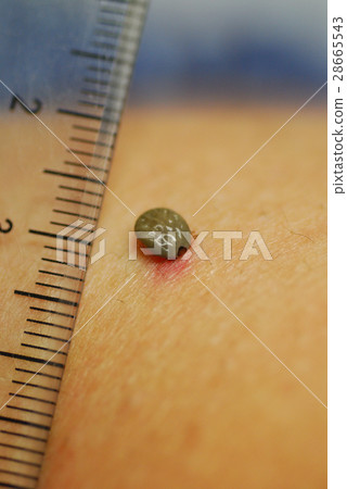 Where biting ticks Where biting ticks 28665543