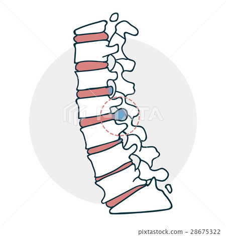 Herniated intervertebral disc icon Herniated intervertebral disc icon 28675322
