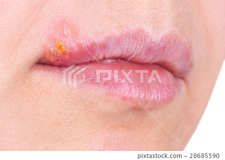 Herpes on the lip close up macro 28685590