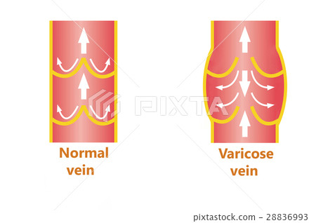 The varicose veins and normal veins The varicose veins and normal veins 28836993