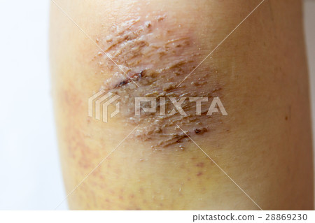 Closed up of red scab injury on woman knee 28869230