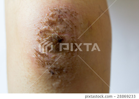 Closed up of red scab injury on woman knee  28869233