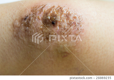 Closed up of red scab injury on woman knee  28869235
