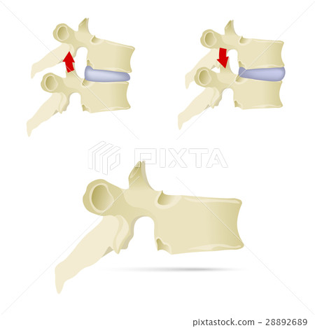Spine, lumbar vertebra. Facet syndrome Spine, lumbar vertebra. Facet syndrome 28892689