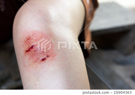 Bruised wound injury on woman knee background Bruised wound injury on woman knee background 28904363