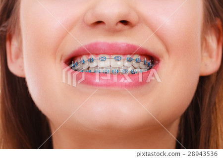 Closeup of woman teeth with braces Closeup of woman teeth with braces 28943536