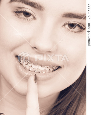 Woman showing her teeth with braces Woman showing her teeth with braces 28943537