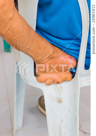 hand of old asian man suffering from leprosy hand of old asian man suffering from leprosy 28965915