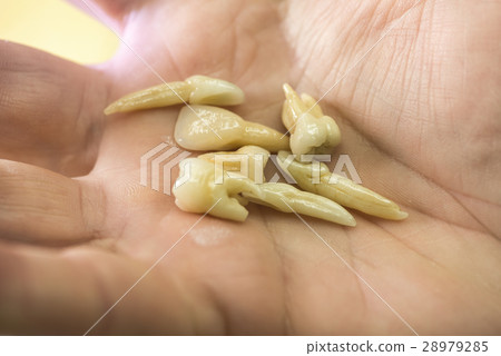 Dental Prosthesis 28979285