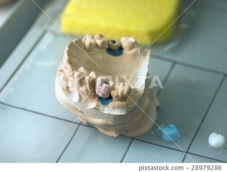 Dental Prosthesis 28979286