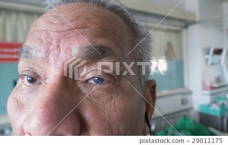 keratopathy bullous condition in eye of patient keratopathy bullous condition in eye of patient 29011175