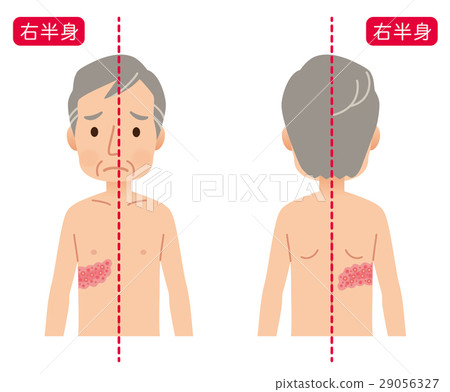 Symptoms of shingles 29056327
